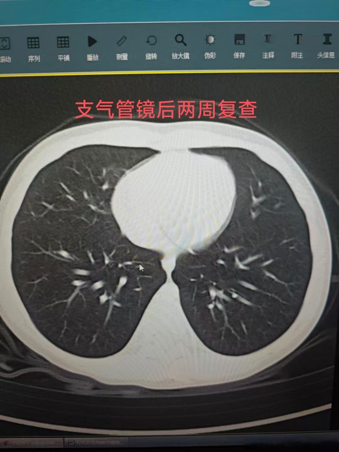 太原确诊肺炎-太原确诊新型冠状病毒肺炎-第3张图片